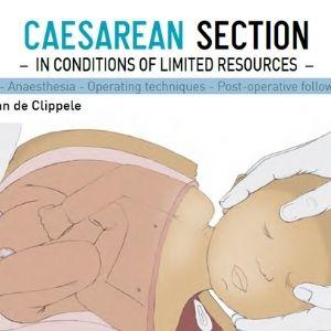 Caesarean section information card